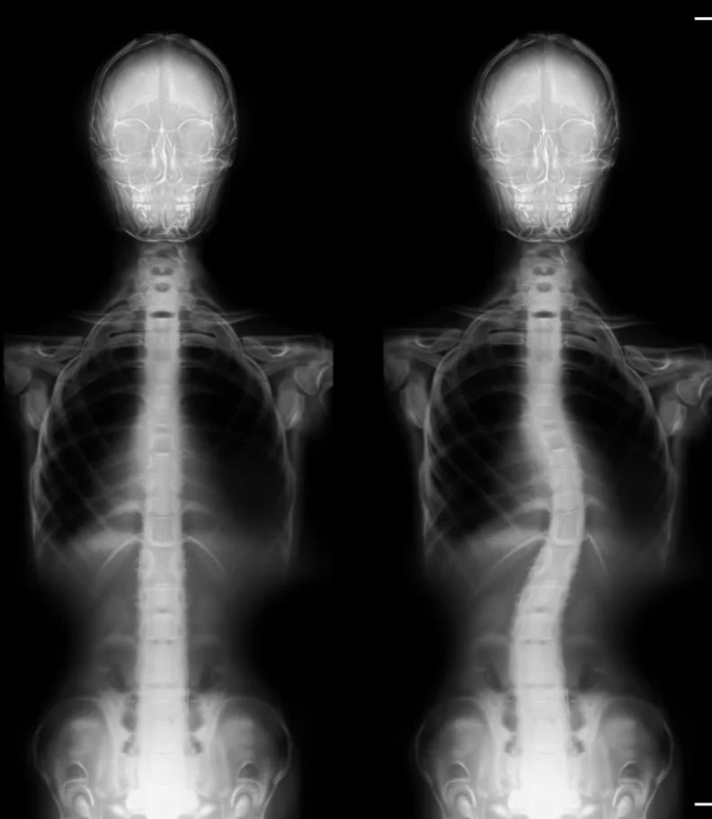 Scoliosis Macomb